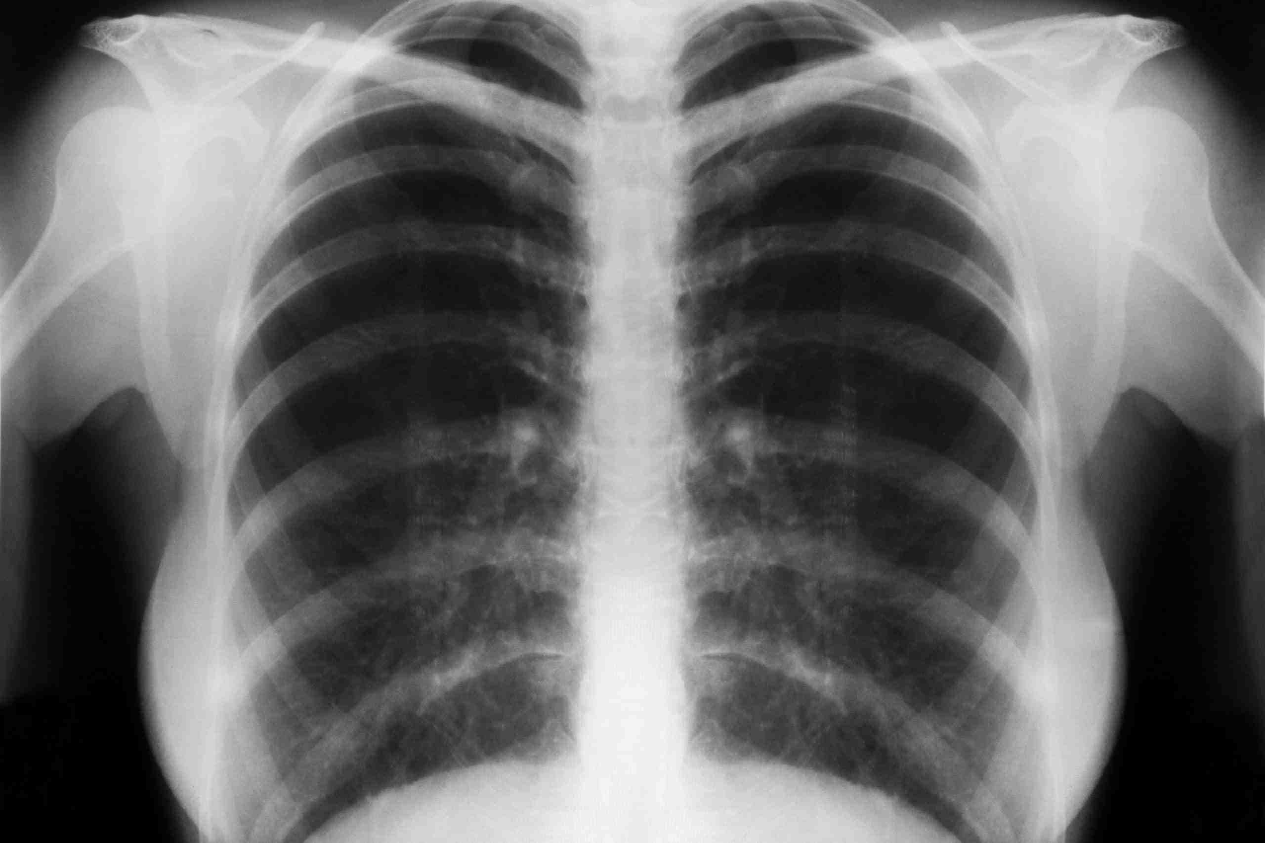 X-Ray